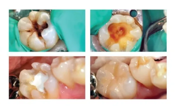 maarc ceraset mta putty maarc ceraset mta putty