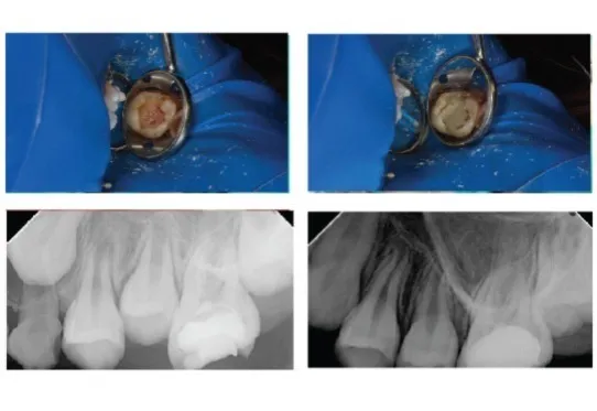 maarc ceraset mta putty maarc ceraset mta putty